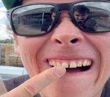 Chris chipped his tooth when he was trying to open a bottle cap with his teeth.